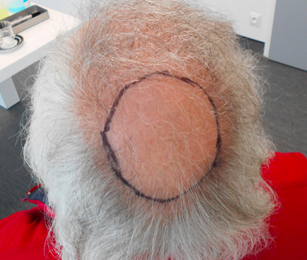 greffe-cheveux-avant-docteur-berkovits