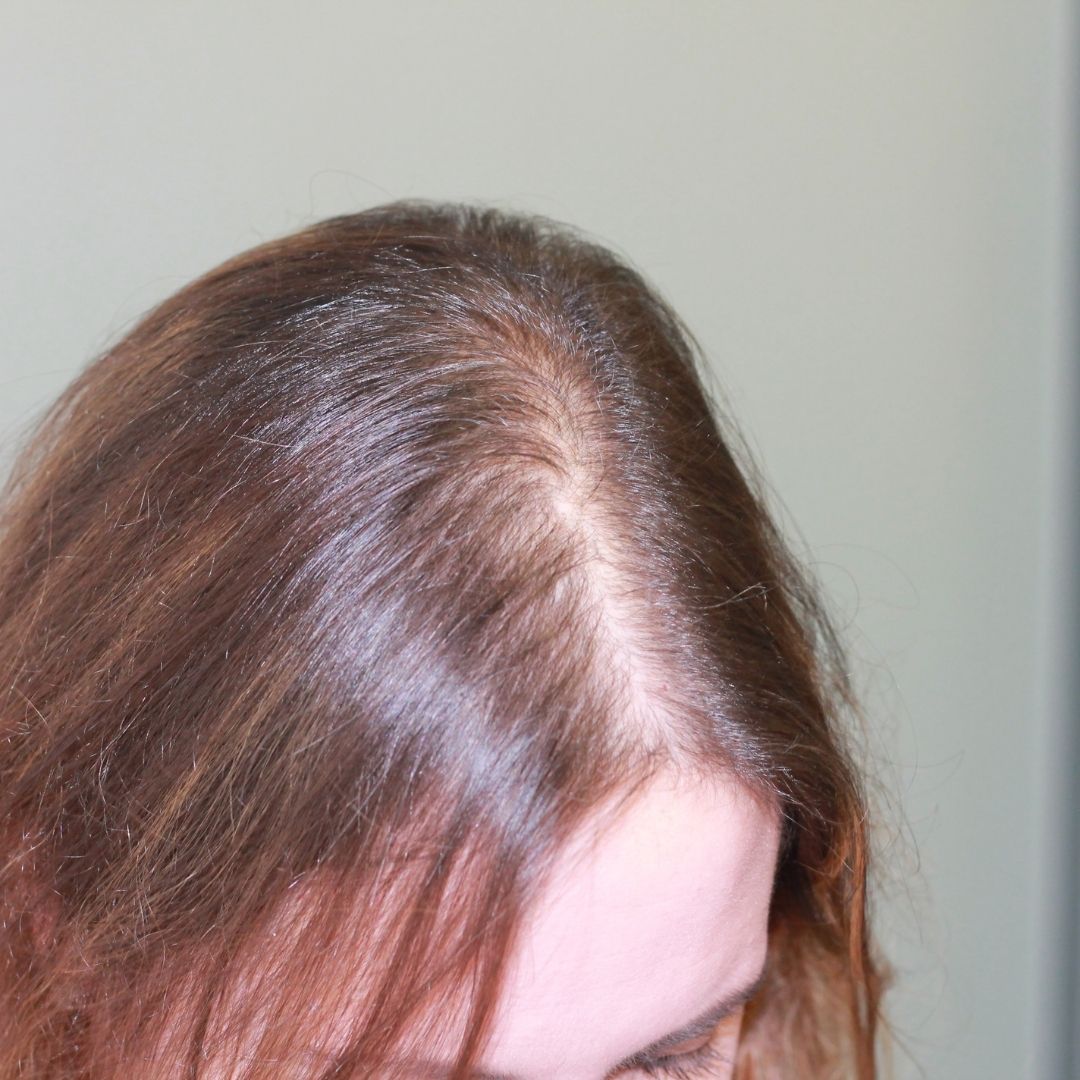 avant-greffe-cheveux